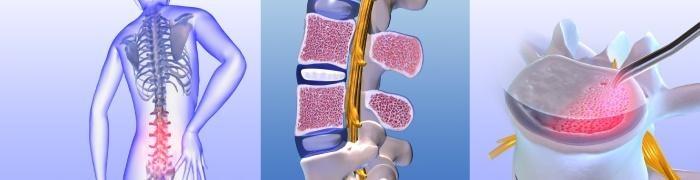 Abrasion-LWS