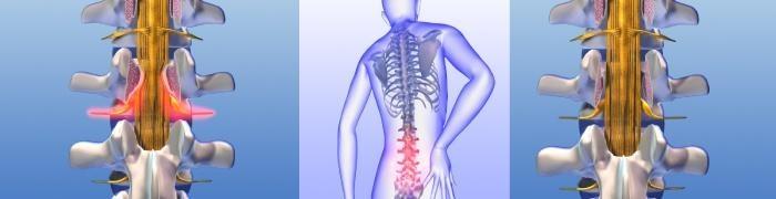 Spinalstenose